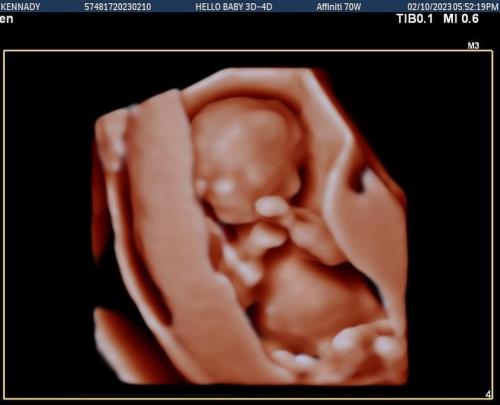 AJ's First Ultrasound! (2/23)